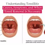 Understanding Tonsillitis: Causes, Symptoms, and When Tonsil Removal Is Necessary