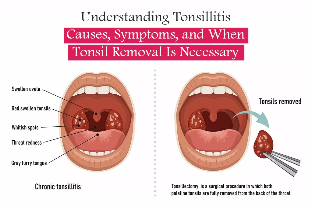 Understanding Tonsillitis: Causes, Symptoms, and When Tonsil Removal Is Necessary